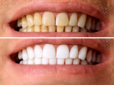 Kolkata, General, AB Dentologic &ndash; Trusted Dental Clinic Newtown For Complete Dental Care