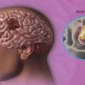 What Are The Common Causes Of Hair Fall And Hair Thinning?