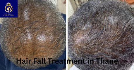 Thane, Fashion & Design, Best Hair Fall Treatment In Thane &ndash; Expert Solutions At DN A Royal.