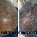 Best Hair Fall Treatment In Thane &ndash; Expert Solutions At DN A Royal.