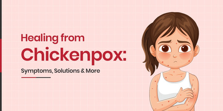 Lucknow, Health, Chickenpox Treatment: Symptoms, Causes & Prevention Guide