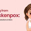 Chickenpox Treatment: Symptoms, Causes & Prevention Guide