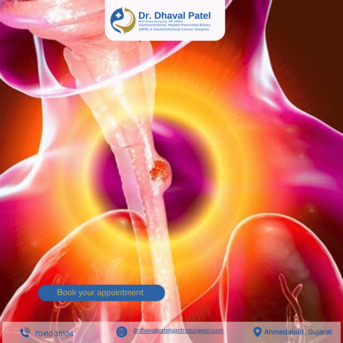 Ahmedabad, Health, Leading Cancer Surgery For Esophageal Cancer In Ahmedabad By Dr. Dhaval Patel