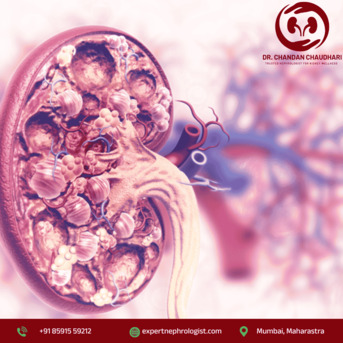 Mumbai, Health, Chronic Kidney Disease Diagnosis & Treatment In Mumbai | Dr. Chandan Chaudhari