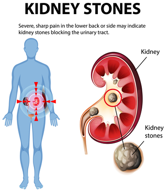 Mumbai, Health, Top Benefits Of Ayurvedic Treatment For Kidney Stones