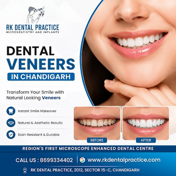 Chandigarh, Dental, Dental Veneers In Chandigarh For Cosmetic Smile Enhancement
