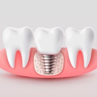 Kolkata, Dental, Get Back Your Complete Smile At A Trusted Dental Implant Clinic In Kolkata