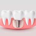 Get Back Your Complete Smile At A Trusted Dental Implant Clinic In Kolkata
