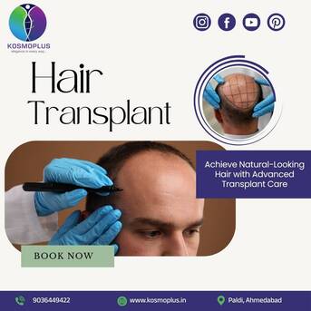 Ahmedabad, Health, Get A Younger, Fuller Look With A Hair Transplant In Ahmedabad