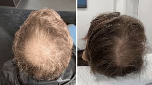 Mumbai, Health, How Does PRP Therapy Support Natural Hair Regrowth?