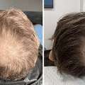 How Does PRP Therapy Support Natural Hair Regrowth?