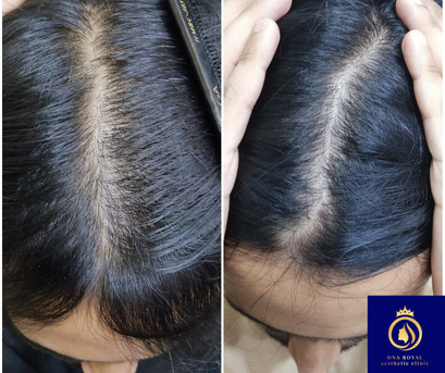 Thane, Fashion & Design, DNA Royal Offers The Best Hair Regrowth For Women In Thane.