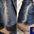 DNA Royal Offers The Best Hair Regrowth For Women In Thane.