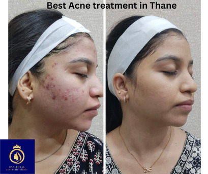 Thane, Fashion & Design, Best Acne Treatment In Thane &ndash; Advanced Acne Care At DNA Royal.