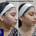 Best Acne Treatment In Thane – Advanced Acne Care At DNA Royal.