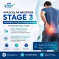 Avascular Necrosis Stage 3 Treatment Without Surgery In India &ndash; HipXpert
