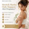 Stretch Marks Aren&rsquo;t Just A Pregnancy Concern