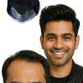 Frontline Hair Patch: The Key To A Natural And Undetectable Hairline