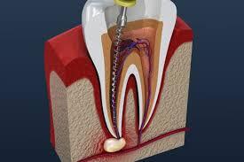 Noida, Health, Root Canal Treatment Cost In Noida At Shree Dental