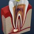 Root Canal Treatment Cost In Noida At Shree Dental
