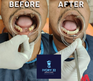Kolkata, Health & Beauty Items, Need Missing Teeth Replacement Or Want To Fix A Broken Tooth In Barasat? Visit Ivory32