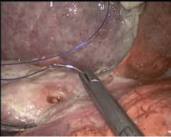 Ahmedabad, Health, Advanced Gastrointestinal Tumor Treatment By Experienced Specialists