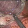 Advanced Gastrointestinal Tumor Treatment By Experienced Specialists