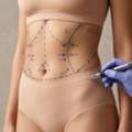 Tummy Tuck Cape Town Specialist Abdominoplasty By Dr Gareth Tjasink
