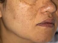 New Delhi, Health, Pigmentation Treatment In Delhi | Skin Pigmentation Specialist