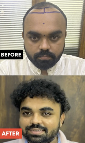 Ahmedabad, Health, Best Hair Transplant In Gujarat