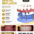 Advanced Dental Clinic In Sainikpuri For Dental Implants