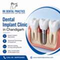 Dental Implant Clinic In Chandigarh For Advanced Tooth Replacement