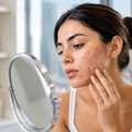 The Hidden Reasons Acne Can Be Harder To Treat In Dubai