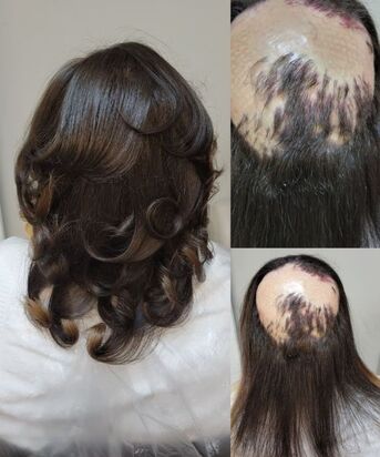 New York, Medical, Hair Loss Specialist Georgia | Hair Clinique Restoration Center &ndash; Book Your Consultation T