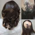 Hair Loss Specialist Georgia | Hair Clinique Restoration Center &ndash; Book Your Consultation T