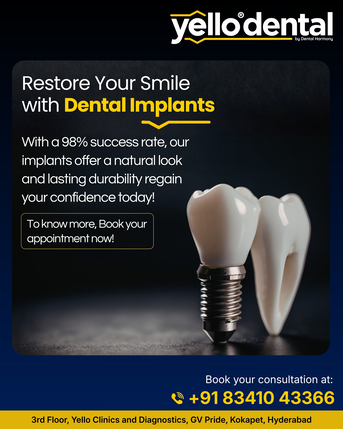 Hyderabad, Dental, Dental Implants In Kokapet