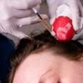 Top Benefits Of Getting PRP Treatment In Dubai