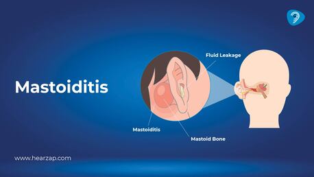 Hyderabad, Health & Beauty Items, INR 30,  Mastoiditis: Symptoms, Causes, Treatment & Prevention Guide