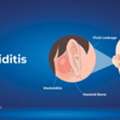 INR 30,  Mastoiditis: Symptoms, Causes, Treatment & Prevention Guide