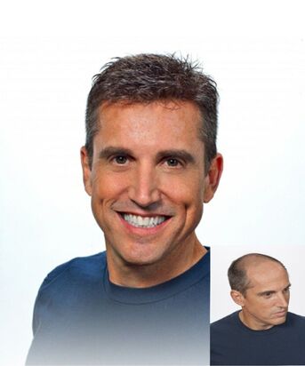 New York, Marketing, Best Treatment For Thinning Hair In Georgia | Hair Clinique Restoration Center