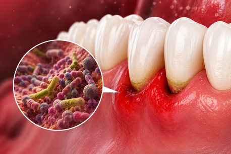 New York, Dental, Can A Loose Tooth Be Saved Without Extraction?