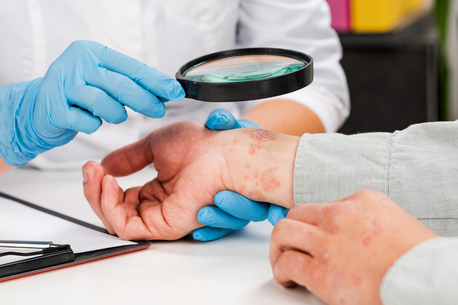Istanbul, Health, ALEX Moleküler Alerji Testi