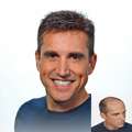 Transform Hair Thinning Into Fuller, Healthier Hair | Hair Clinique Restoration Center