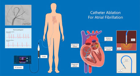 Dubai, Health, Best Cardiac Care For Atrial Fibrillation Ablation | The Heart.ae