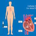 Best Cardiac Care For Atrial Fibrillation Ablation | The Heart.ae