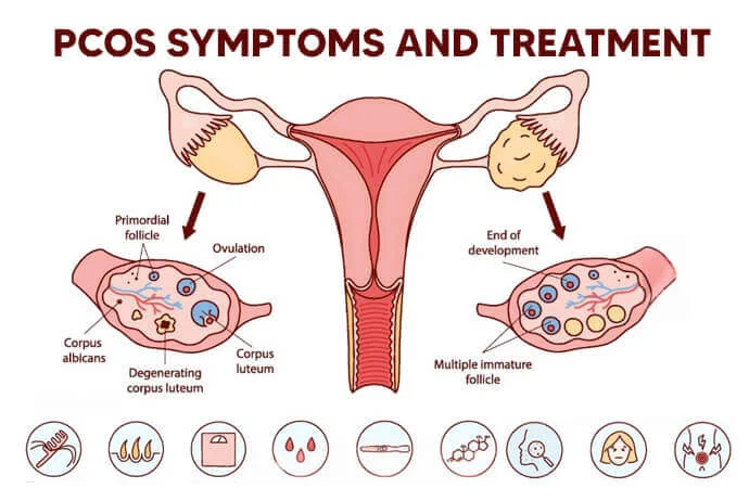 New Delhi, Health, PCOS Treatment In Delhi
