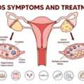 PCOS Treatment In Delhi