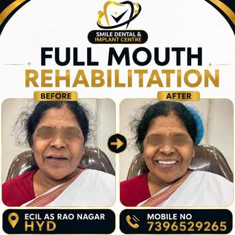 Hyderabad, Dental, Full Mouth Rehabilitation | Top Dental Clinic & Dentist Near Me