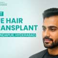FUE Hair Transplant In Hyderabad To Restore Hair Density Naturally