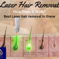 Achieve Smooth Skin With Best Laser Hair Removal In Thane By DNA Royal.